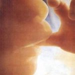 Neonata operata di cesareo: era incinta della gemella parassita