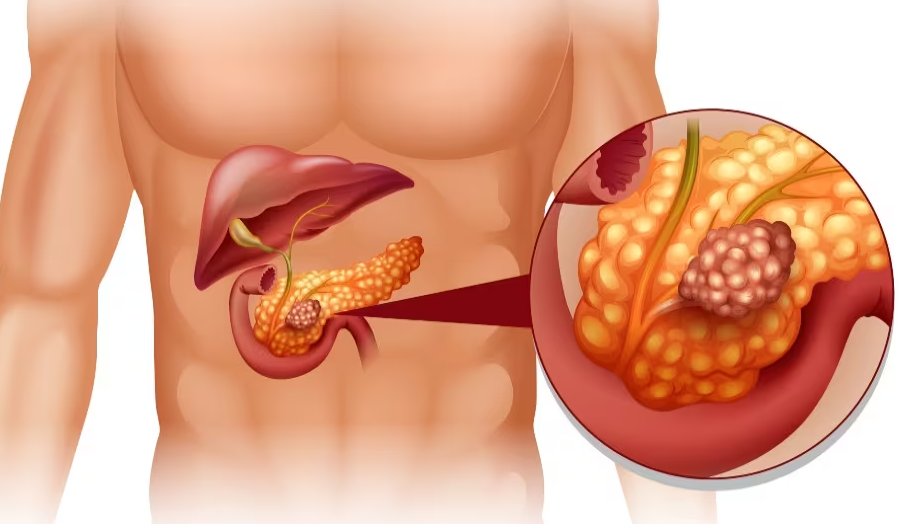 Tumore al pancreas: questi 2 segnali ne indicano la presenza due o tre anni prima della diagnosi